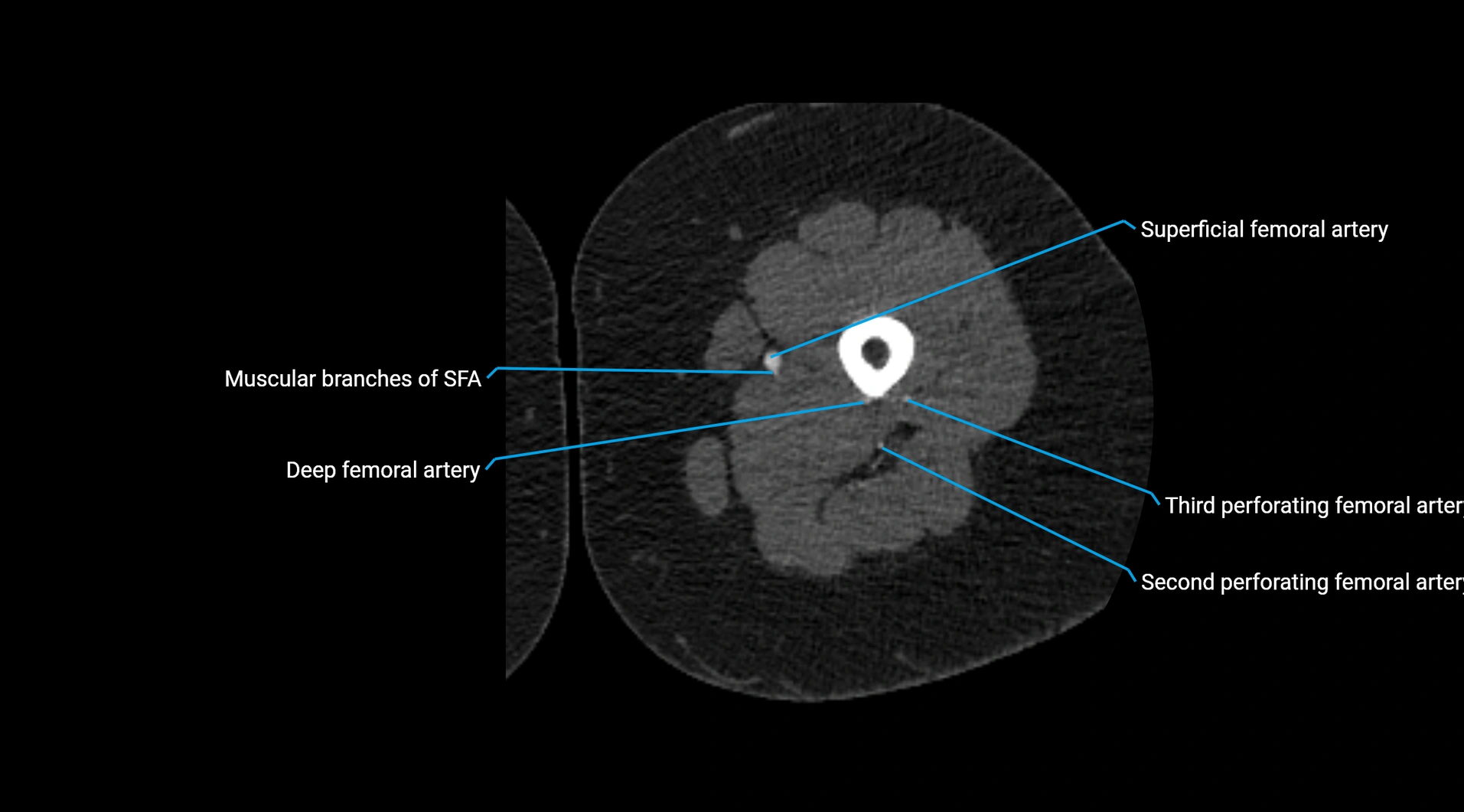 CTA lower limb cross sectional anatomy labelled image _123.webp